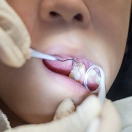 Close up of dentist giving a child a dental exam