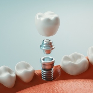 Illustrated model of a dental implant in Nepean replacing a missing tooth