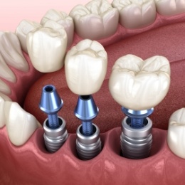 Illustration of three dental crowns being attached to three dental implants