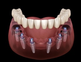 Illustrated full denture being placed onto six dental implants