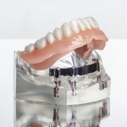 Model of an implant denture