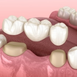 Illustrated dental bridge replacing a missing tooth