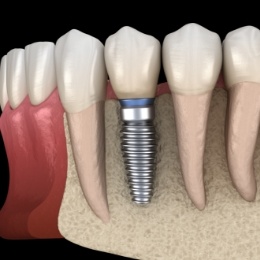 Illustrated dental implant replacing a missing tooth