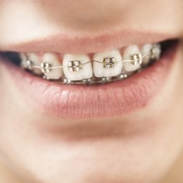 Close up of person with traditional braces smiling