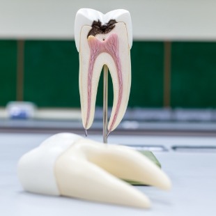 Model of damaged tooth needing root canal treatment in Nepean