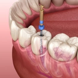 Illustrated dental instrument treating the inside of a tooth