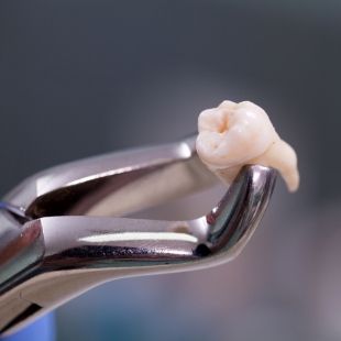 Dental clasp holding an extracted tooth